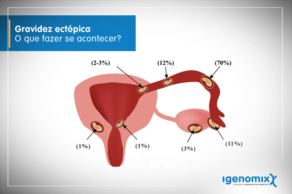 ilustração do aparelho reprodutor identificando onde pode ocorrer a gravidez ectópica