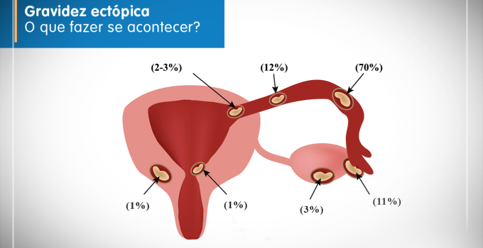 ilustração do aparelho reprodutor identificando onde pode ocorrer a gravidez ectópica