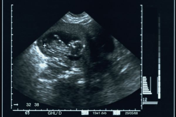 ultrassom morfológico ve sexo do bebê