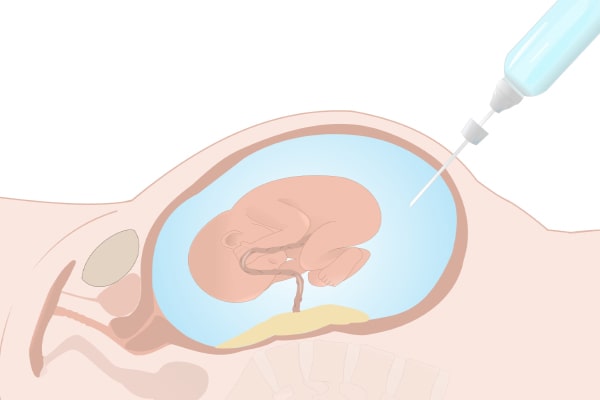 amniocentese