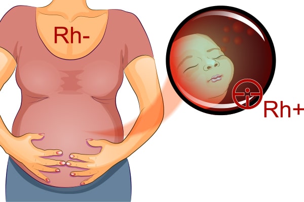 vacina rogan para fator rh materno-fetal