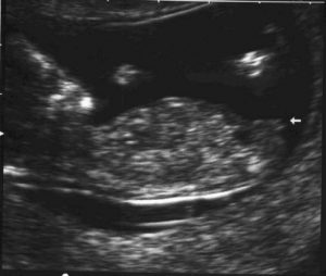 tubérculo genital